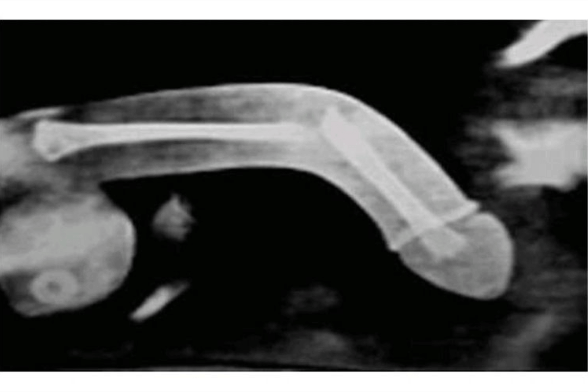 Penisbruch / penis fracture