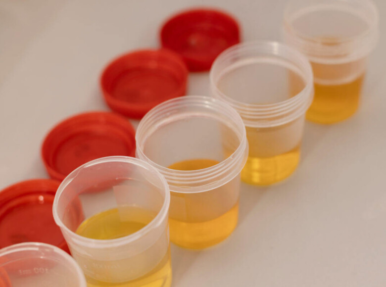 Blut im Urin Symbolbild: Urinproben in Bechern. Englisch: blood in urine symbolic image: Urine samples in cups