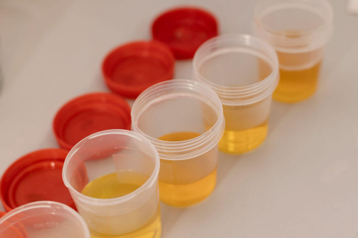 Blut im Urin Symbolbild: Urinproben in Bechern. Englisch: blood in urine symbolic image: Urine samples in cups